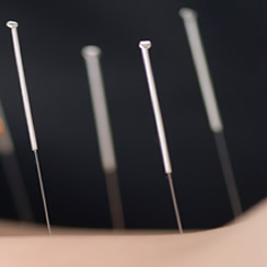 Agujas de Acupuntura